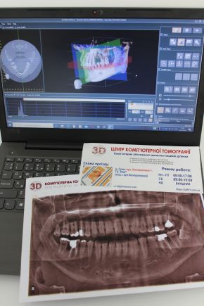 Імплантація зубів, рентген зубів в клініці ГраДент Суми